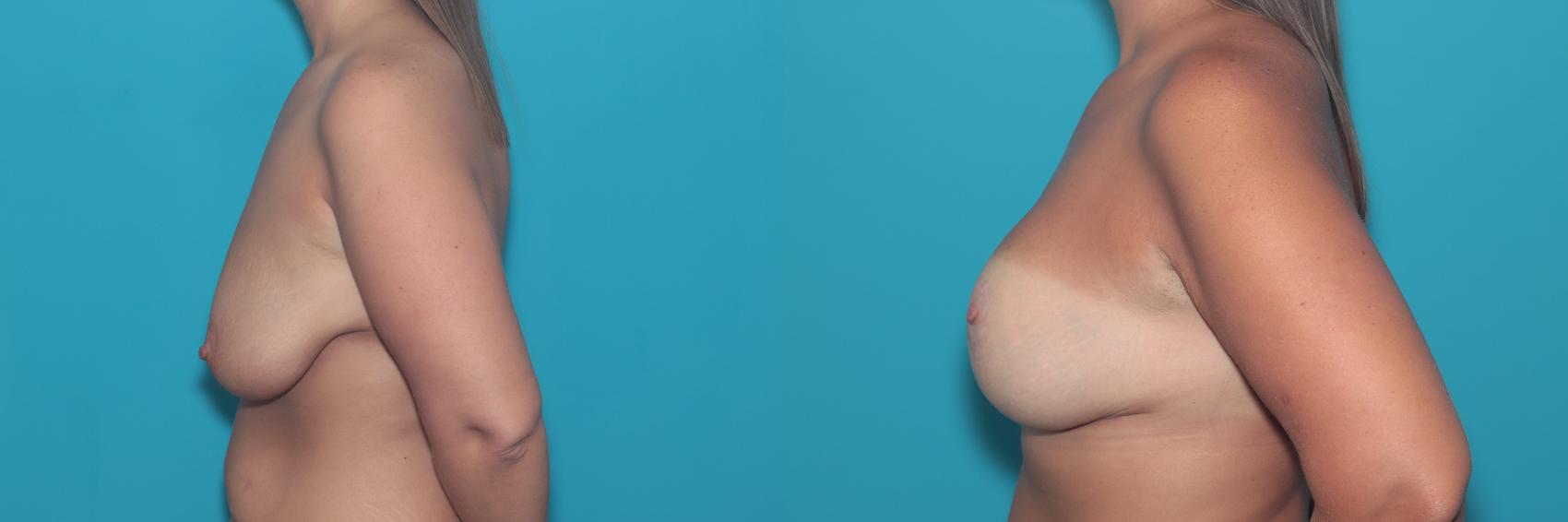 Before & After Breast Lift Case 361 Left Side View in West Des Moines, IA
