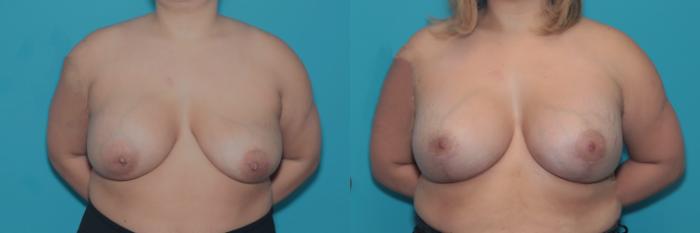 Before & After Breast Lift Case 378 Front View in West Des Moines & Ames, IA