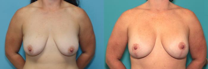 Before & After Breast Augmentation Case 390 Front View in West Des Moines & Ames, IA