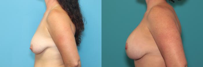 Before & After Breast Lift Case 390 Left Side View in West Des Moines & Ames, IA