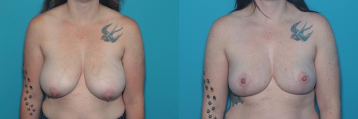 Before & After Breast Lift Case 404 Front View in West Des Moines & Ames, IA