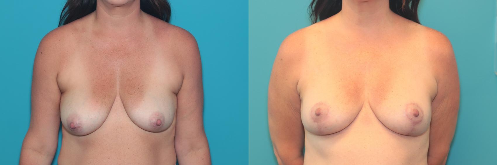 Before & After Breast Lift Case 490 Front View in West Des Moines & Ames, IA