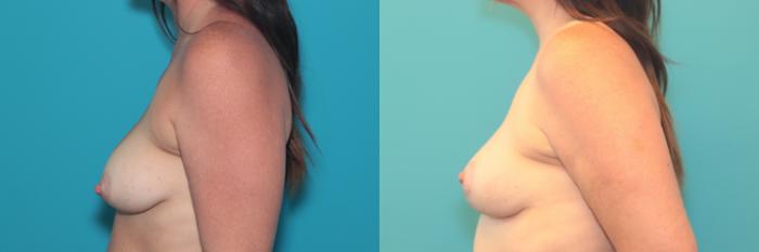 Before & After Breast Lift Case 490 Left Side View in West Des Moines & Ames, IA