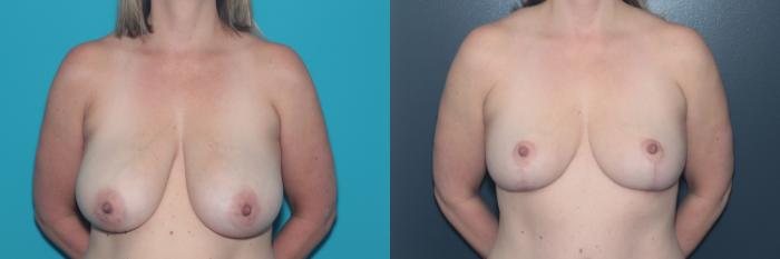 Before & After Breast Lift Case 496 Front View in West Des Moines & Ames, IA