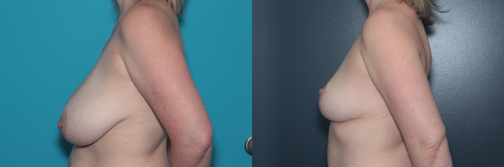 Before & After Breast Lift Case 496 Left Side View in West Des Moines & Ames, IA