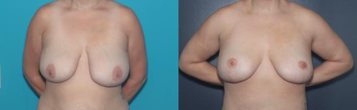 Before & After Breast Lift Case 506 Front View in West Des Moines & Ames, IA