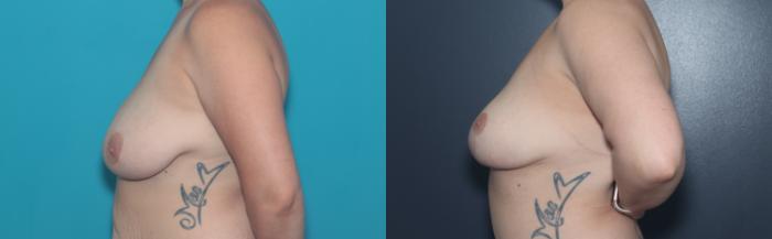 Before & After Breast Lift Case 506 Left Side View in West Des Moines & Ames, IA