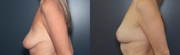 Before & After Breast Lift Case 523 Left Side View in West Des Moines & Ames, IA