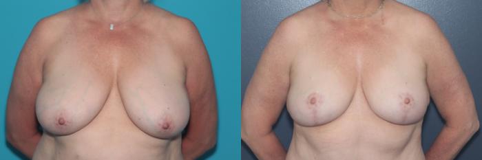 Before & After Breast Lift Case 537 Front View in West Des Moines & Ames, IA