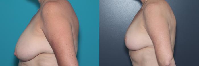 Before & After Breast Lift Case 537 Left Side View in West Des Moines & Ames, IA