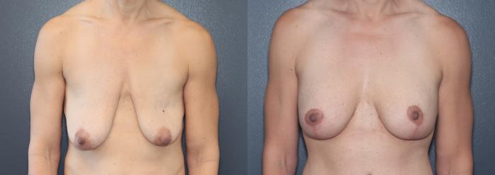 Before & After Breast Lift Case 540 Front View in West Des Moines & Ames, IA