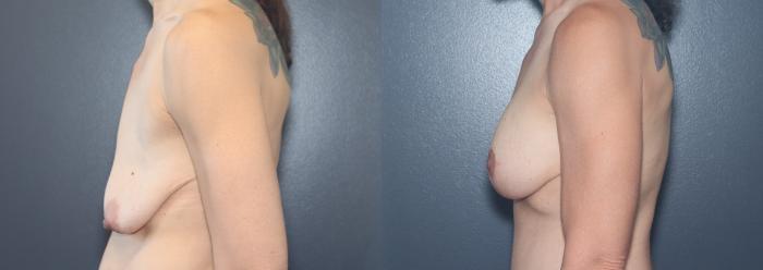 Before & After Breast Lift Case 540 Left Side View in West Des Moines & Ames, IA
