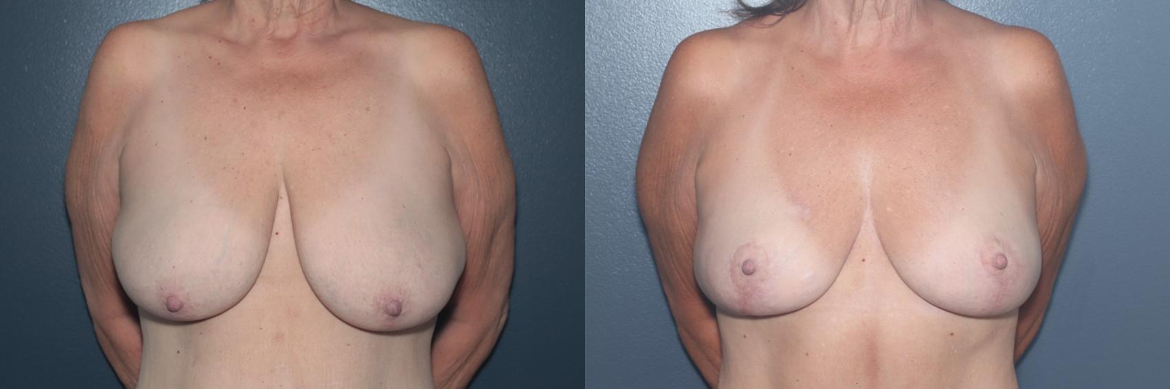 Before & After Breast Lift Case 571 Front View in West Des Moines & Ames, IA