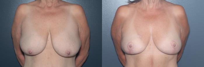 Before & After Breast Lift Case 571 Front View in West Des Moines & Ames, IA