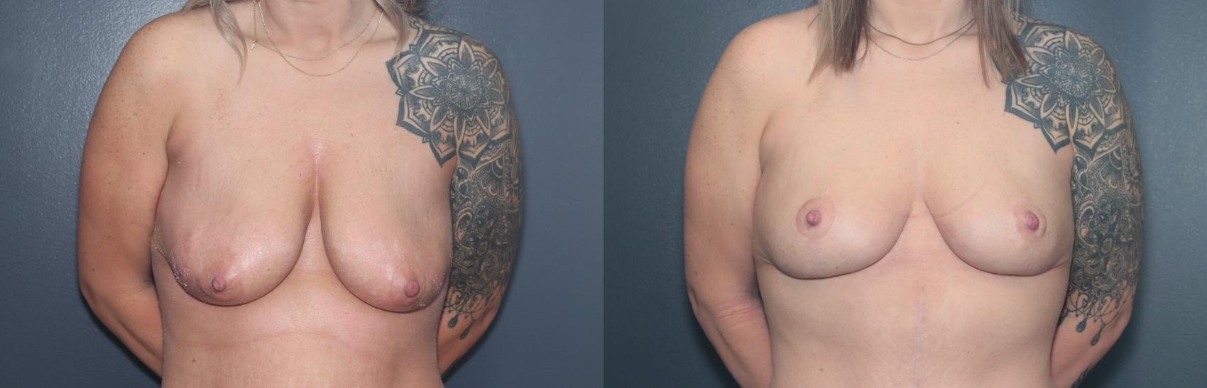 Before & After Breast Lift Case 597 Front View in West Des Moines & Ames, IA