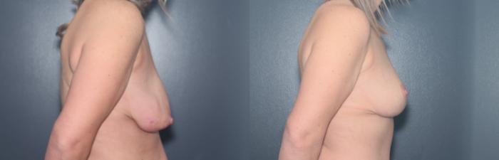 Before & After Breast Lift Case 597 Left Side View in West Des Moines & Ames, IA