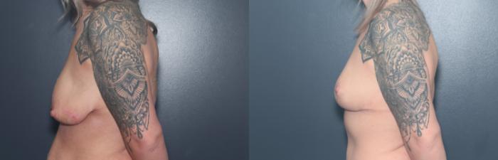 Before & After Breast Lift Case 597 Right Side View in West Des Moines & Ames, IA