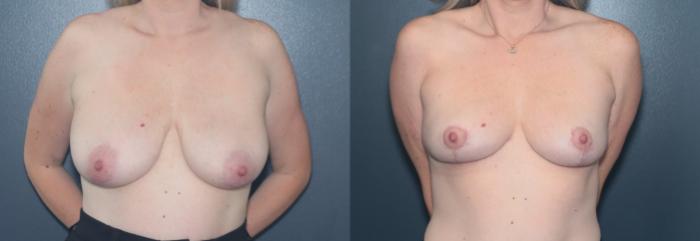 Before & After Breast Lift Case 599 Front View in West Des Moines & Ames, IA
