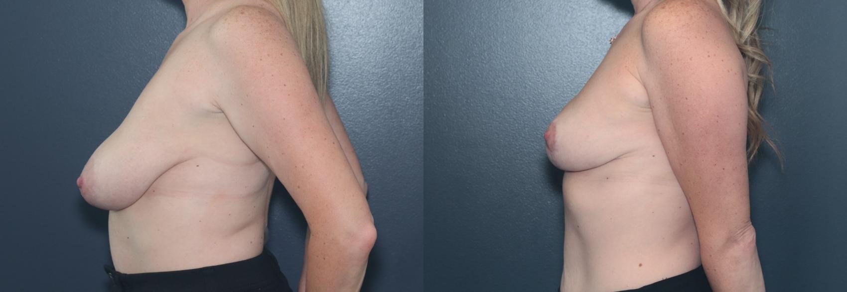 Before & After Breast Lift Case 599 Right Side View in West Des Moines & Ames, IA