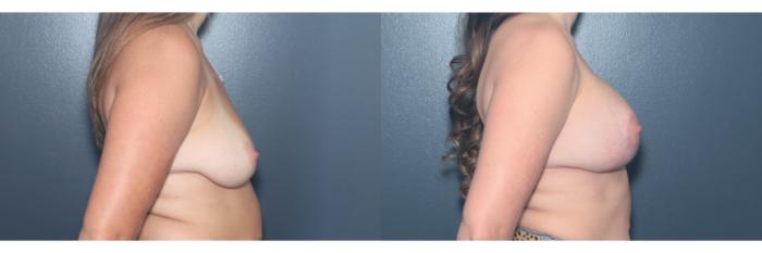 Before & After Breast Lift Case 602 Left Side View in West Des Moines & Ames, IA