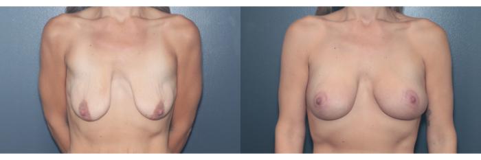 Before & After Breast Lift Case 614 Front View in West Des Moines & Ames, IA