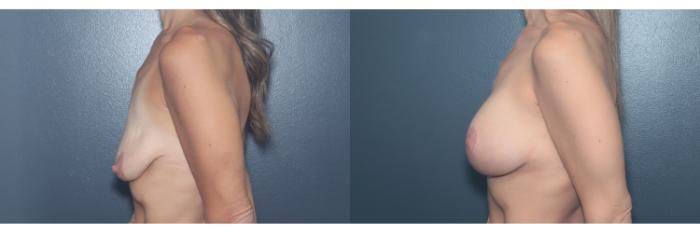 Before & After Breast Lift Case 614 Right Side View in West Des Moines & Ames, IA