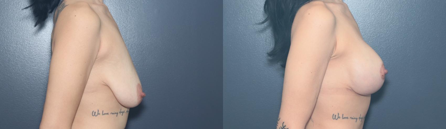 Before & After Breast Lift Case 632 Left Side View in West Des Moines & Ames, IA