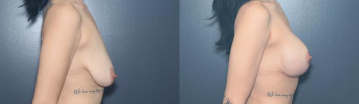 Before & After Breast Lift Case 632 Left Side View in West Des Moines & Ames, IA