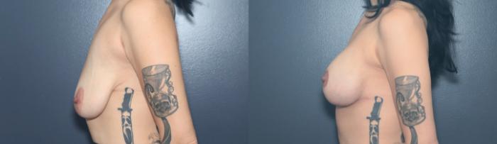 Before & After Breast Lift Case 632 Right Side View in West Des Moines & Ames, IA