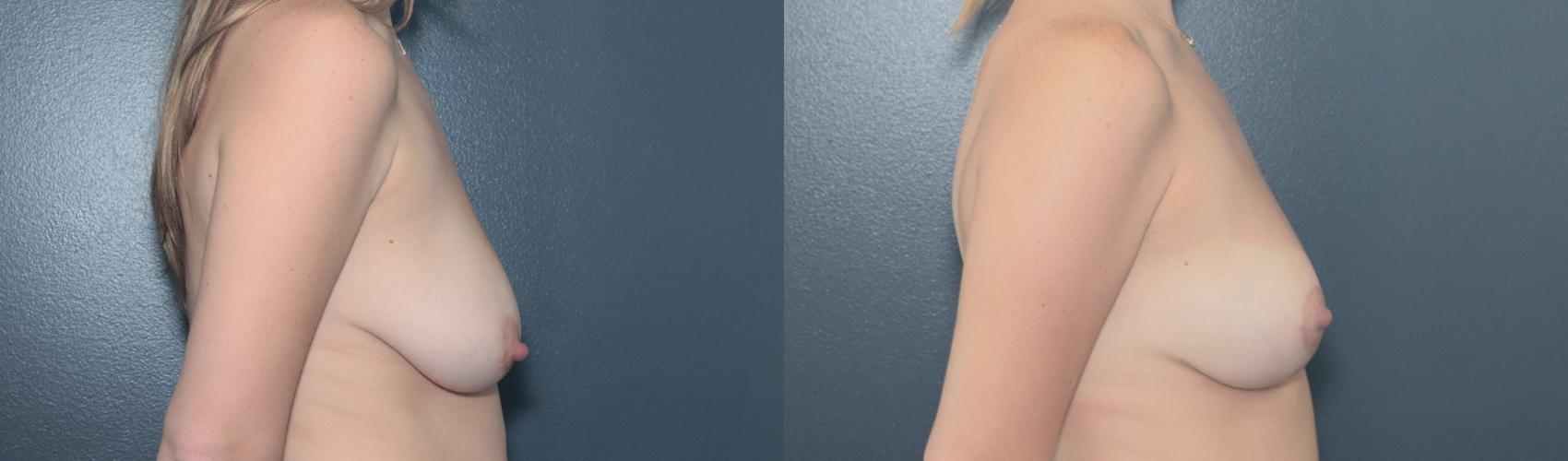 Before & After Breast Lift Case 649 Left Side View in West Des Moines & Ames, IA