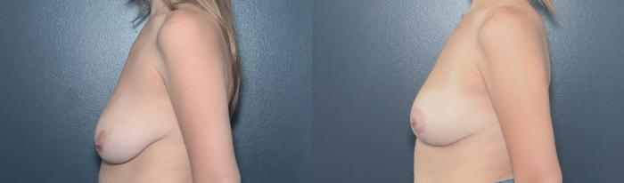 Before & After Breast Lift Case 649 Right Side View in West Des Moines & Ames, IA