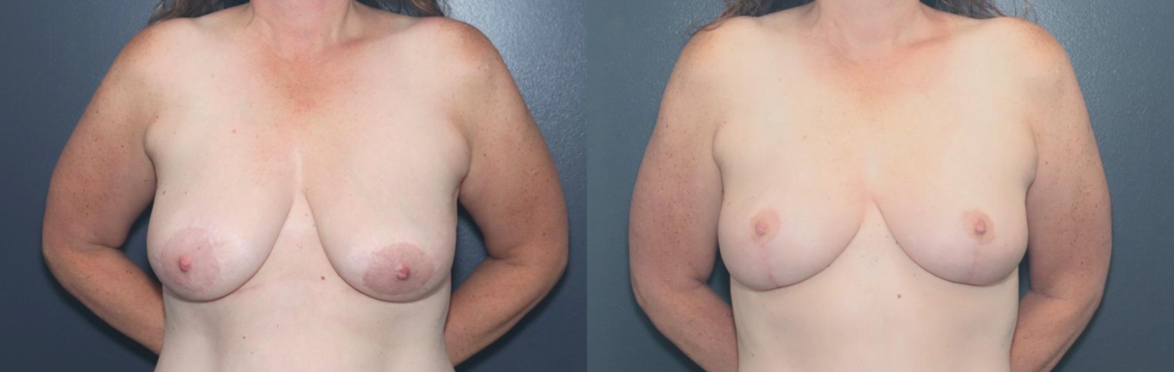 Before & After Breast Lift Case 654 Front View in West Des Moines & Ames, IA