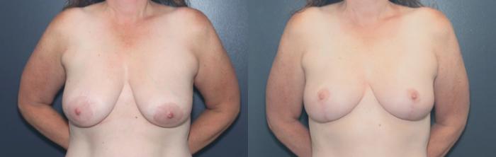 Before & After Breast Lift Case 654 Front View in West Des Moines & Ames, IA