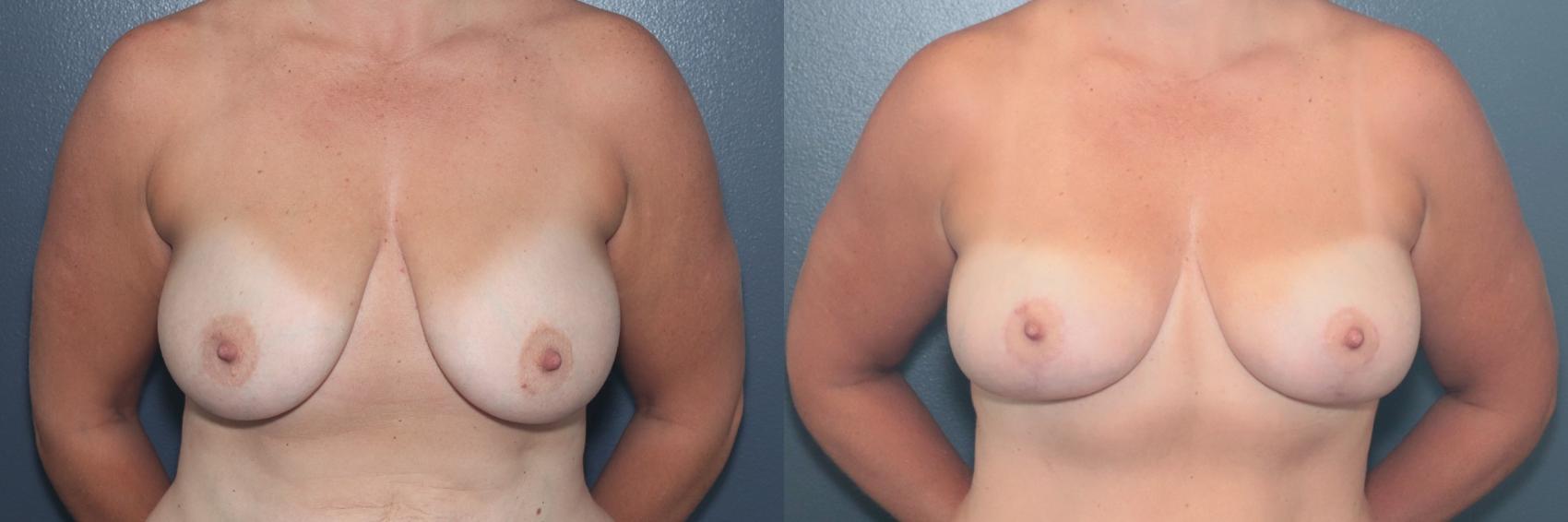 Before & After Breast Lift Case 656 Front View in West Des Moines & Ames, IA