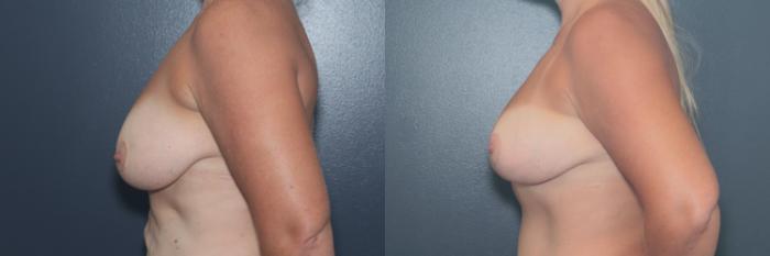 Before & After Breast Lift Case 656 Right Side View in West Des Moines & Ames, IA