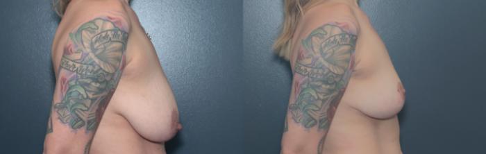 Before & After Breast Lift Case 665 Left Side View in West Des Moines & Ames, IA