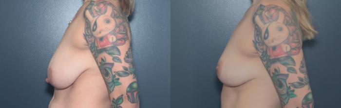 Before & After Breast Lift Case 665 Right Side View in West Des Moines & Ames, IA