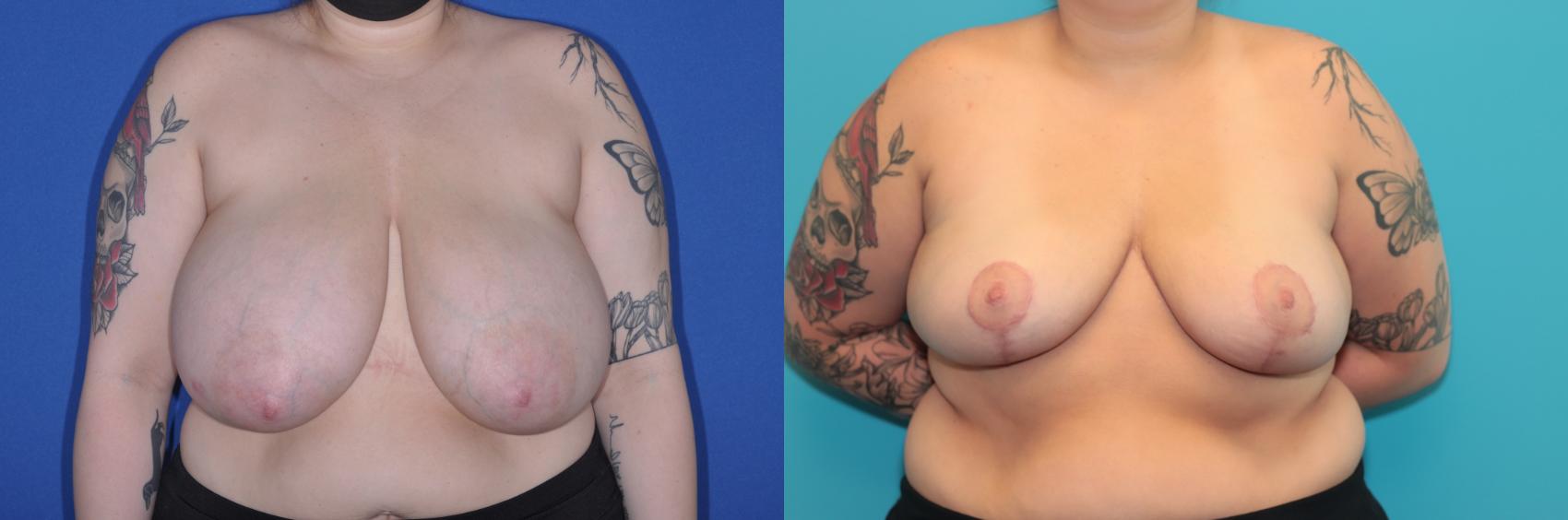 Before & After Breast Reduction Case 232 Front View in West Des Moines & Ames, IA