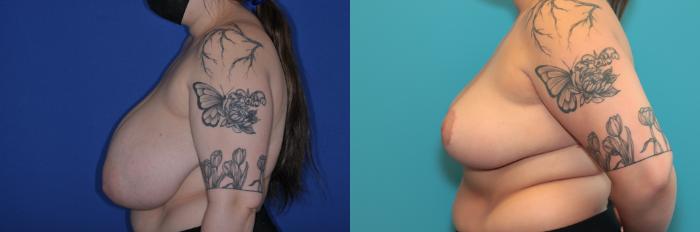 Before & After Breast Reduction Case 232 Left Side View in West Des Moines & Ames, IA