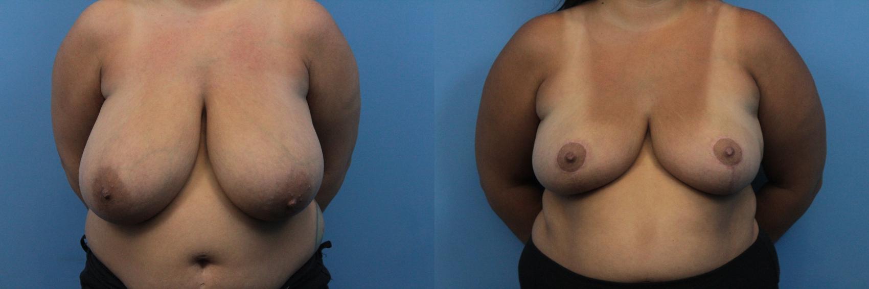 Before & After Breast Reduction Case 268 Front View in West Des Moines, IA