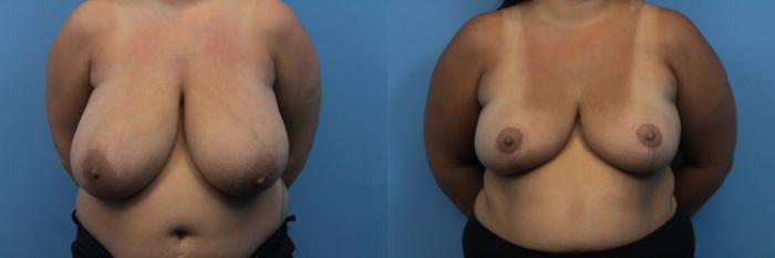 Before & After Breast Reduction Case 268 Front View in West Des Moines & Ames, IA