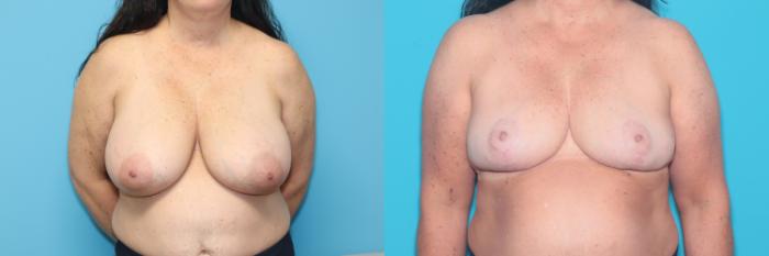Before & After Breast Reduction Case 278 Front View in West Des Moines & Ames, IA