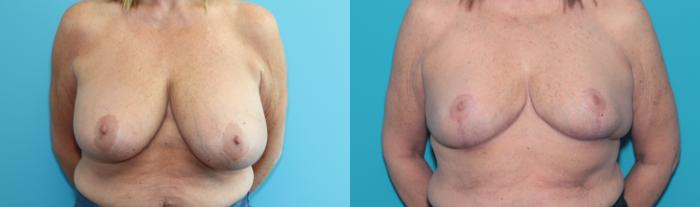 Before & After Breast Reduction Case 323 Front View in West Des Moines & Ames, IA