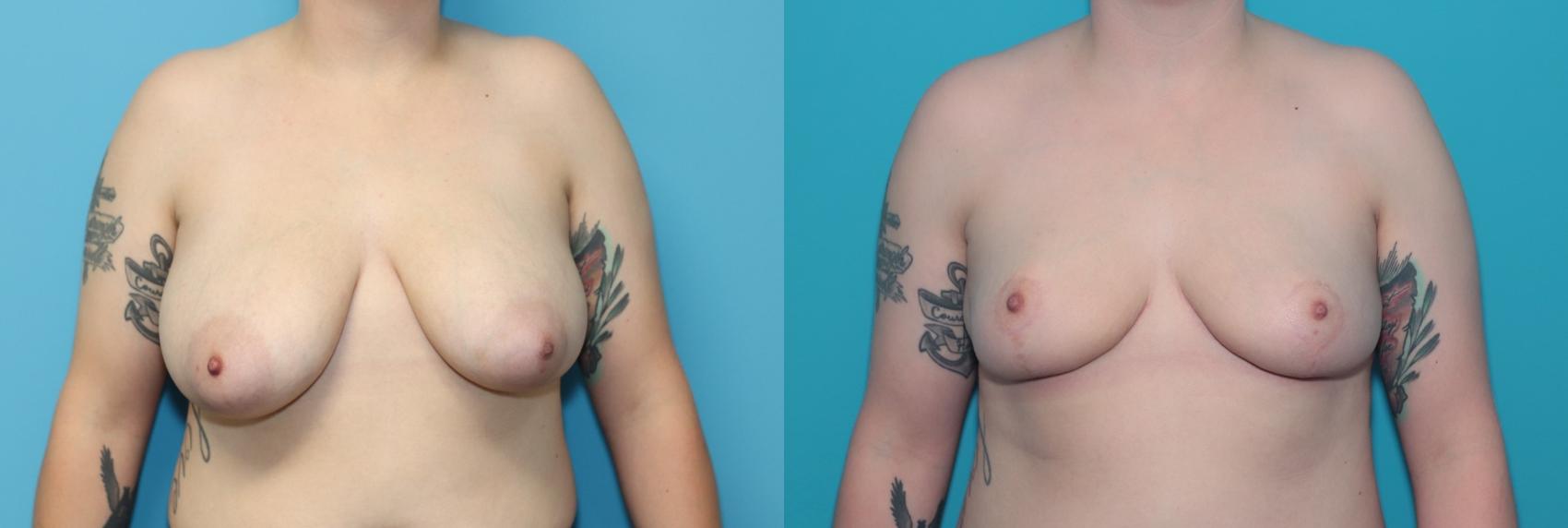 Before & After Breast Reduction Case 326 Front View in West Des Moines & Ames, IA