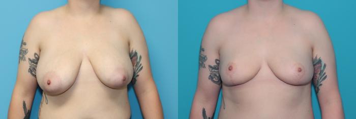 Before & After Breast Lift Case 326 Front View in West Des Moines, IA