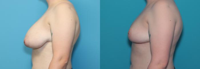 Before & After Breast Reduction Case 326 Left Side View in West Des Moines & Ames, IA