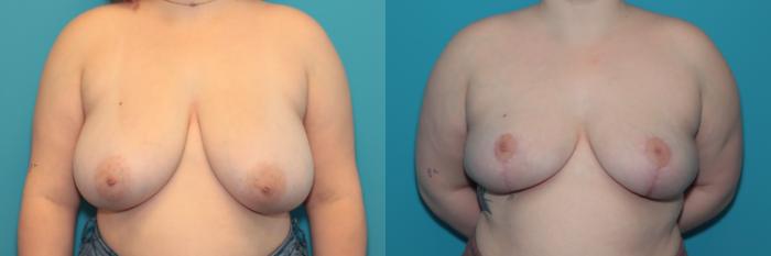 Before & After Breast Reduction Case 333 Front View in West Des Moines & Ames, IA