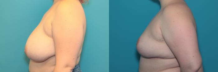 Before & After Breast Reduction Case 333 Left Side View in West Des Moines & Ames, IA