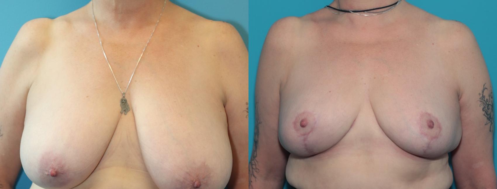 Before & After Breast Reduction Case 334 Front View in West Des Moines & Ames, IA