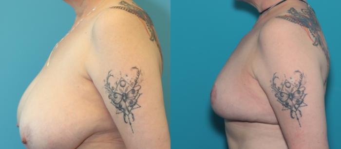 Before & After Breast Reduction Case 334 Left Side View in West Des Moines & Ames, IA